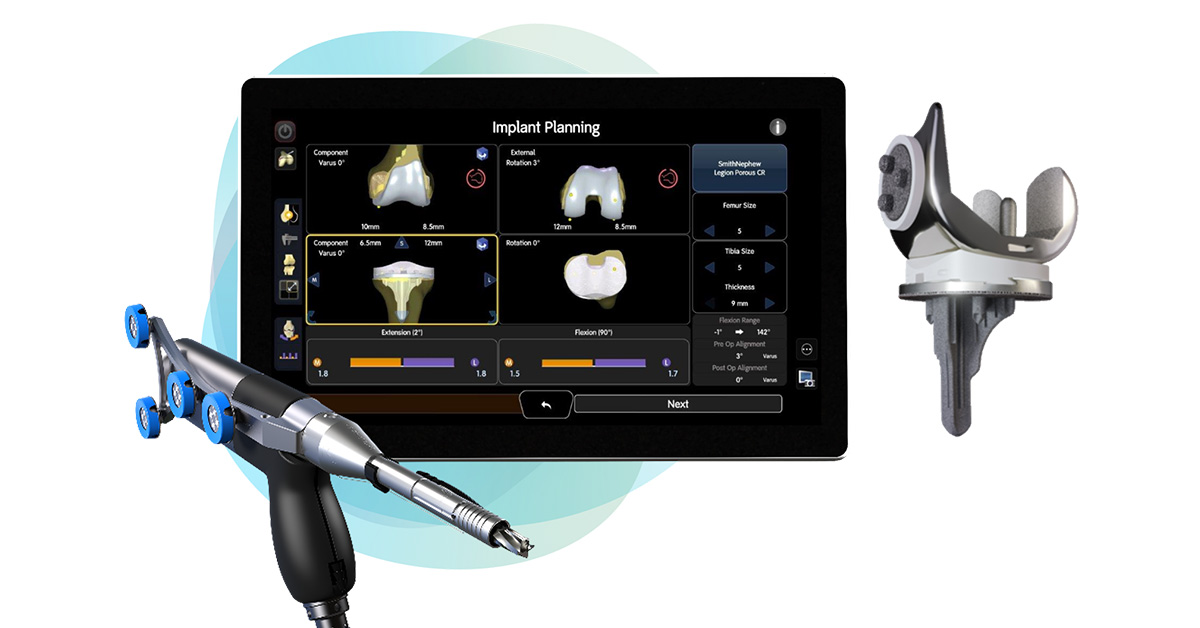 Smith+Nephew announces first robotic-assisted surgery using its LEGION◊ CONCELOC◊ Cementless Total Knee System