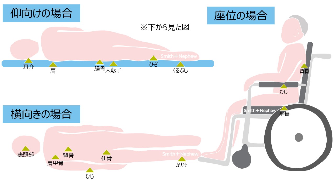 C-褥瘡好発部位.jpg