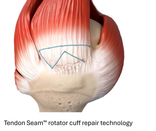 Tendon Seam 1.jpg