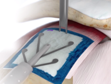 REGENETEN Tendon Anchor Placement.png