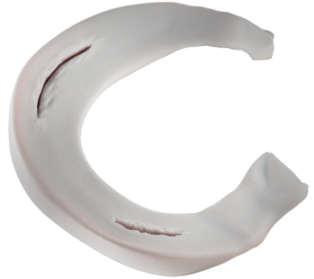 02_Vertical_PreOp_Meniscus_01_01.png
