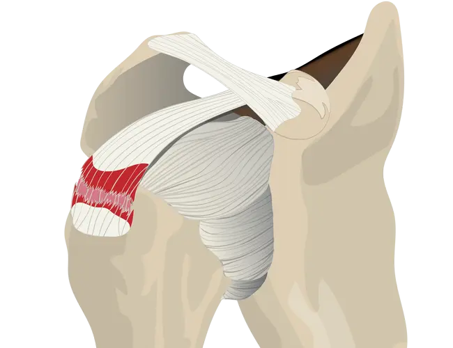 partial thickness tear.png