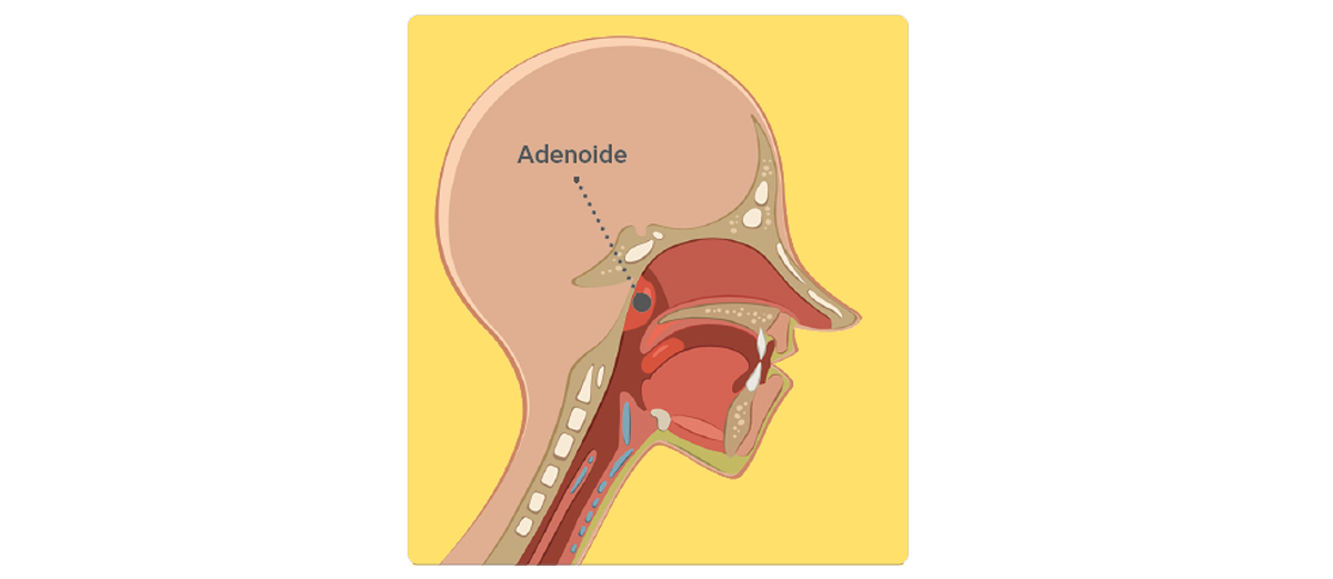 Adenoids