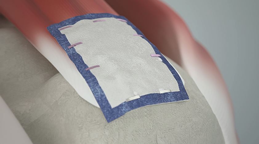 REGENTEN Patch Patient