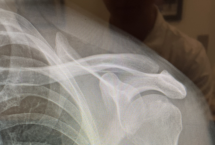 Image of a patient X-ray, used to decide when to use a REGENETEN Implant on a partial-thickness rotator cuff tear repair.
