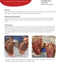 Zolfaghari Bilateral Feet Burn Case Study