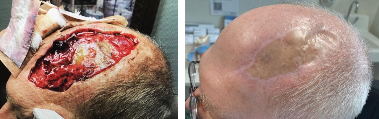 STRAVIX on scalp, basal cell carcinoma remova