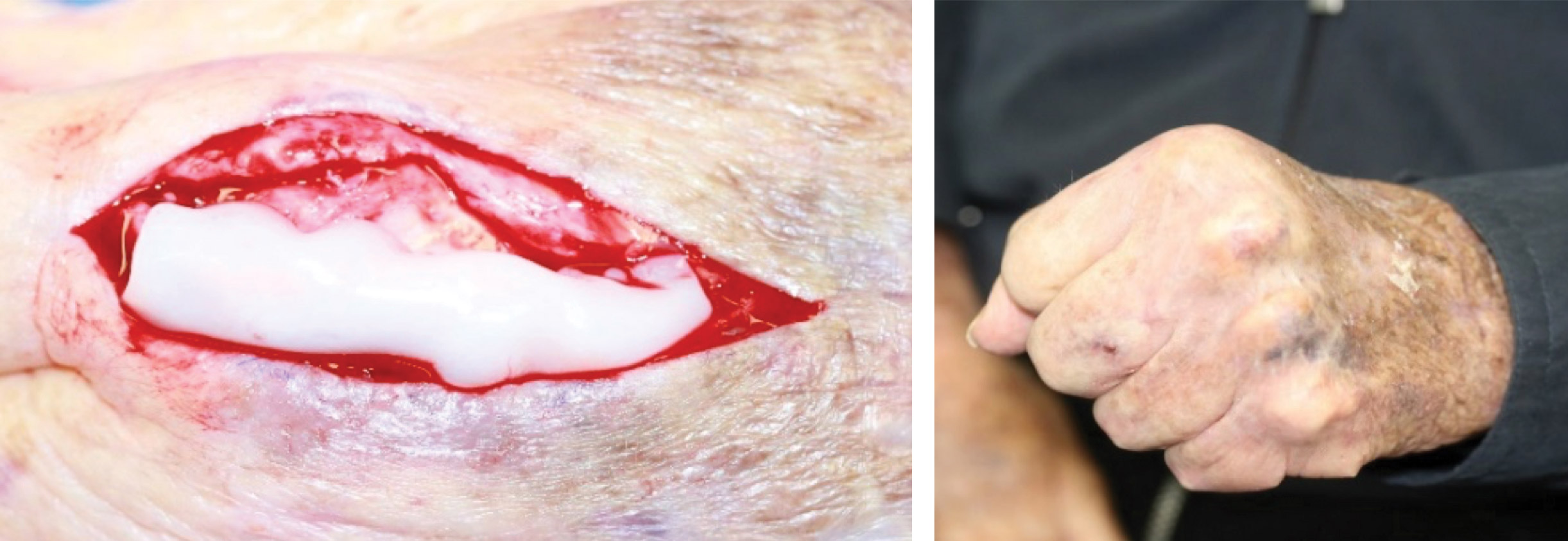 Extensor tendon exposure/tenodesis