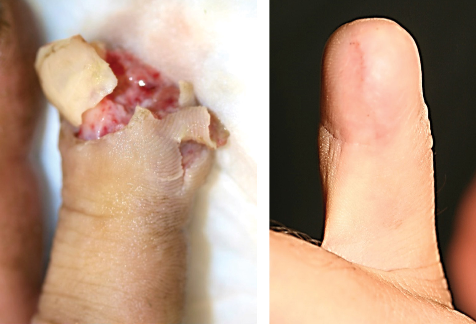 Cover of a painful digital neuroma