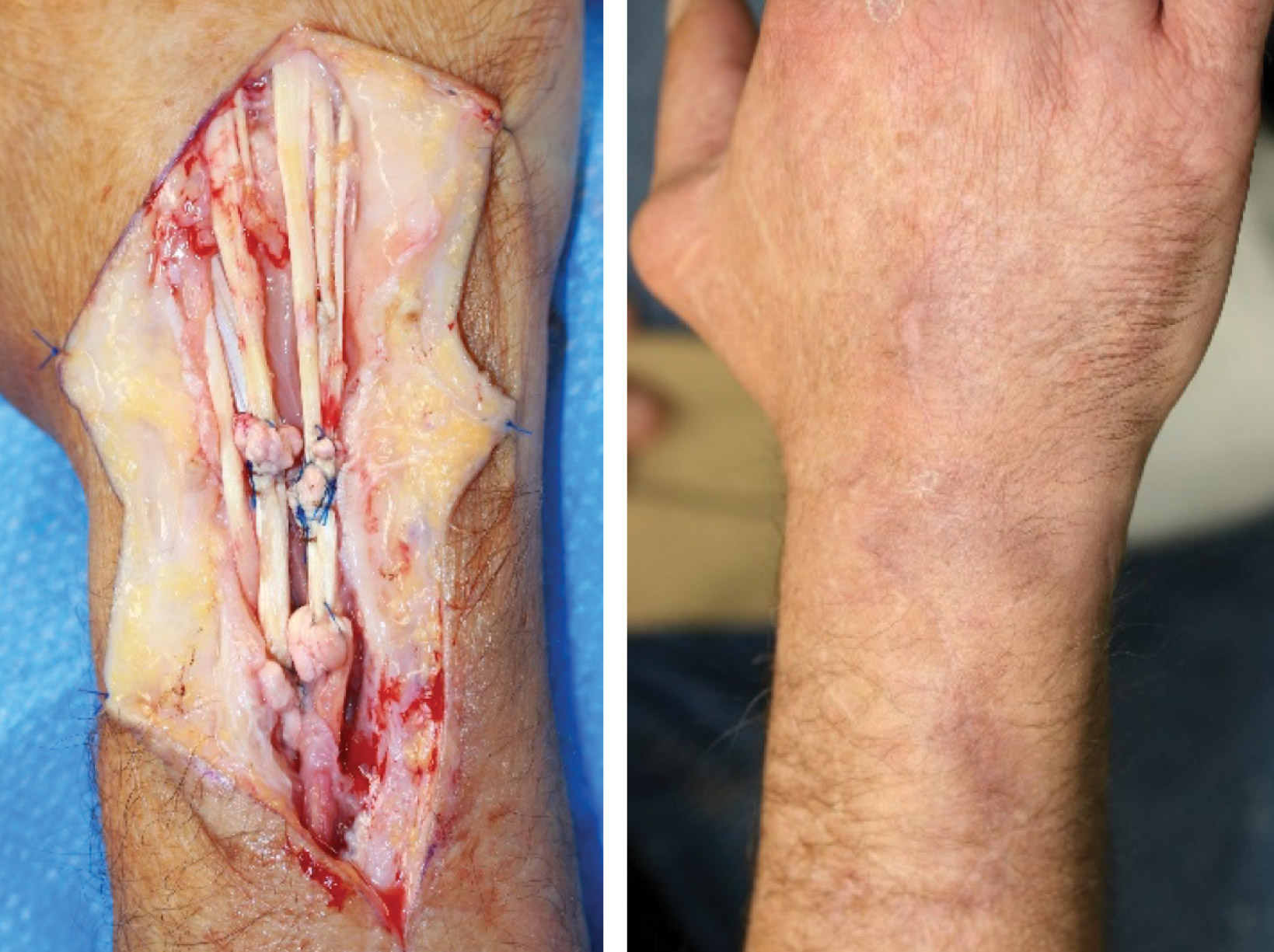 Tendon rupture/graft repair