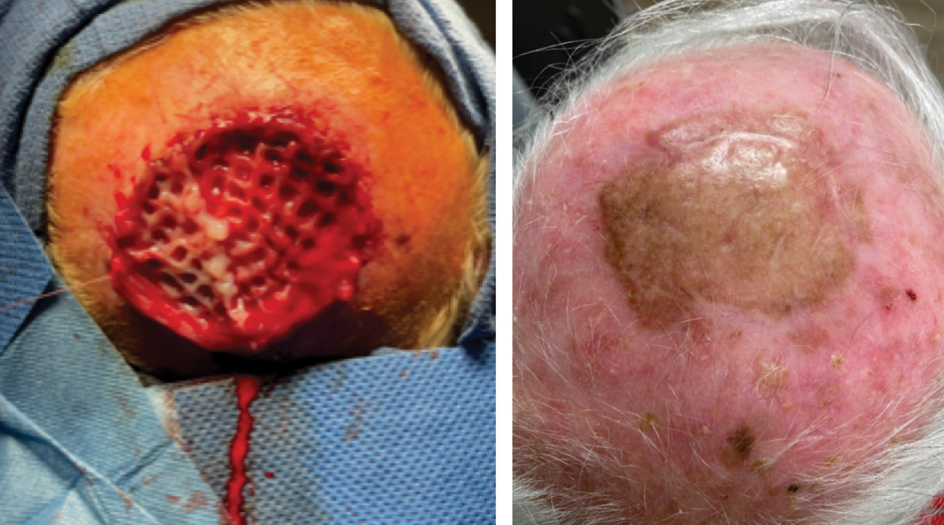 Scalp reconstruction with STRAVIX Meshed Tissue